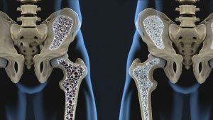 Osteoporoza - Cardios Novi Sad